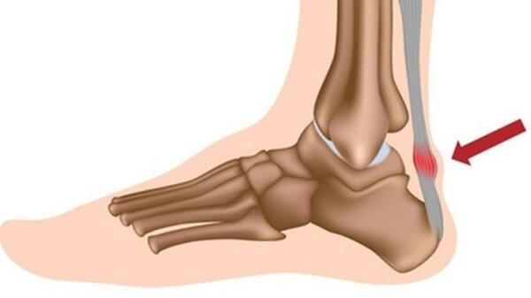 Viêm gân gót chân Achilles có nguy hiểm không? Bao lâu thì khỏi?